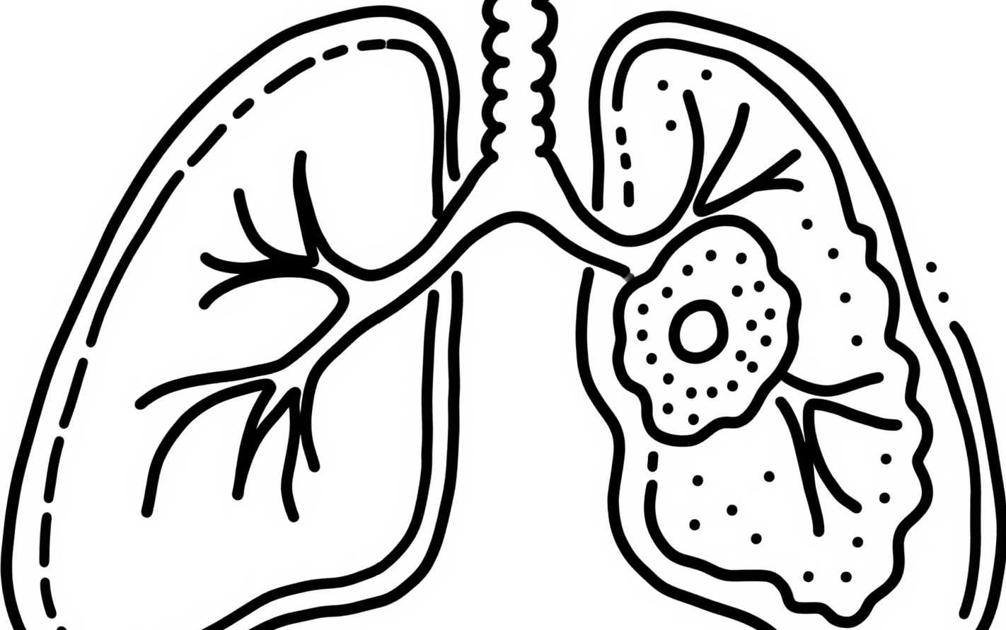 成都治肺癌的老中医